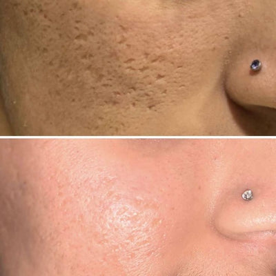 Blackhead remover vaccum - professional skin care tool